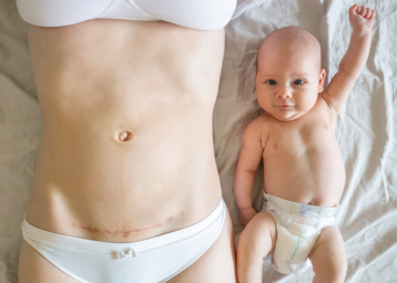 Episiotomy Scar Pain , treatment in Surat by Dr. Ashutosh Shah