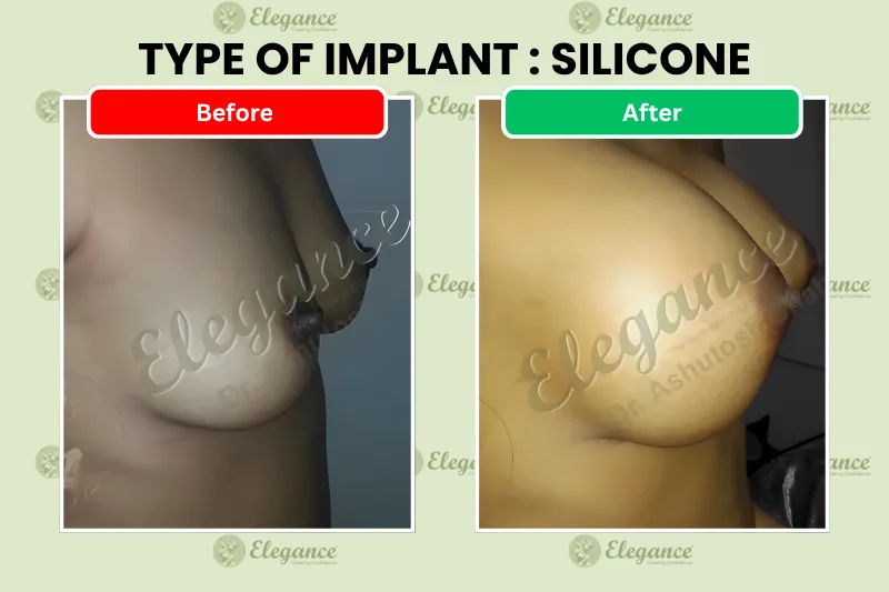 Breast Augmentation with silicone implant before and after – Dr. Ashutosh Shah, Elegance Clinic, Surat