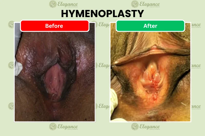 Hymenoplasty before and after results – Dr. Ashutosh Shah, Elegance Clinic, Surat