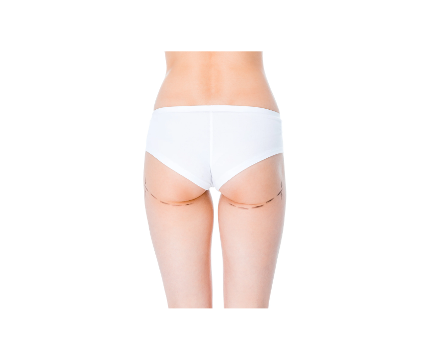 Hip Augmentation in India by Dr. Ashutosh Shah, Elegance Clinic