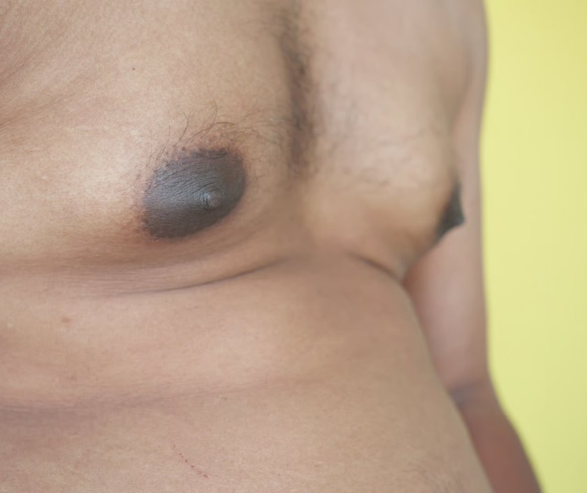 Chest Sculpting, Athletic Contouring, Male Chest Contouring in India at Elegance Clinic, Surat