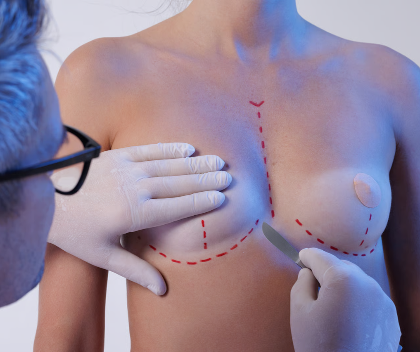 Capsular Contracture Correction, Breast Implant Revision in India at Elegance Clinic, Surat