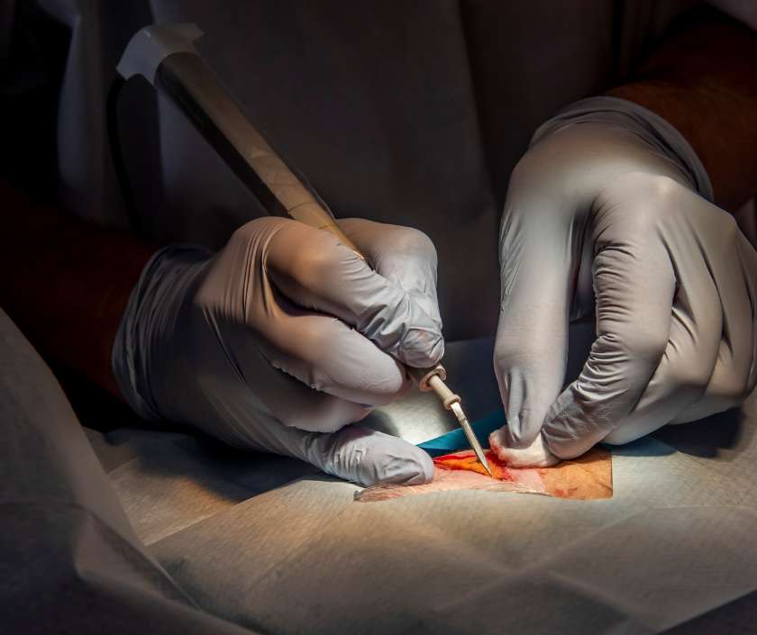 Gland Excision, Gynecomastia in India at Elegance Clinic, Surat