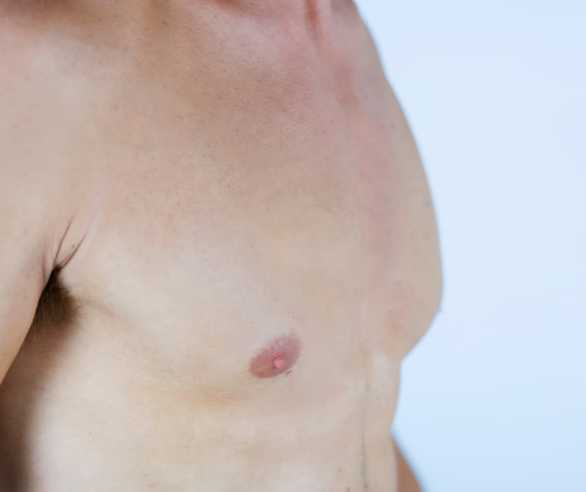 Skin Tightening, Gynecomastia in India at Elegance Clinic, Surat