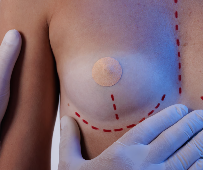 Inverted Nipple Correction, Nipple & Areola Surgery in India at Elegance Clinic, Surat