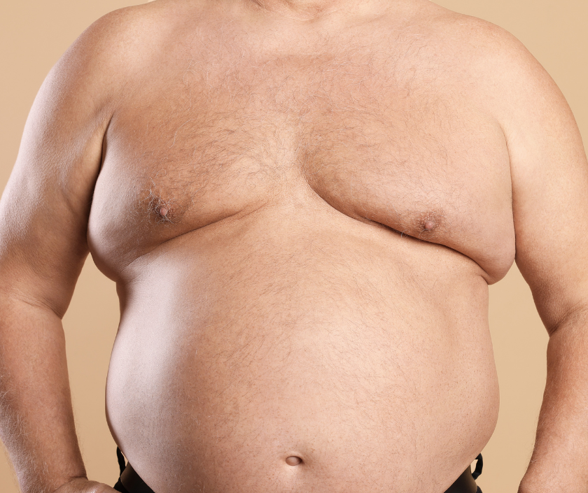 Post Massive Weight Loss Male Chest Correction, Male Chest Contouring in India at Elegance Clinic, Surat