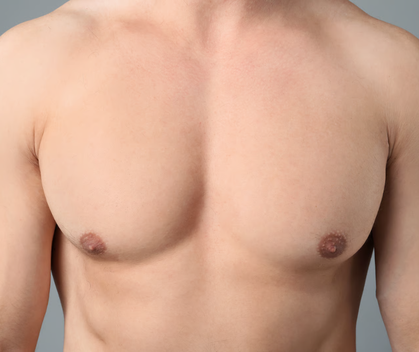 Puffy Nipple Correction, Male Chest Contouring in India at Elegance Clinic, Surat