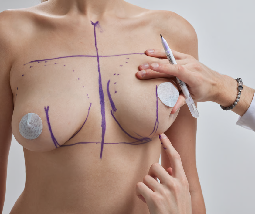 Sagging Breasts After Pregnancy treatment in India by Dr. Ashutosh Shah, Elegance Clinic