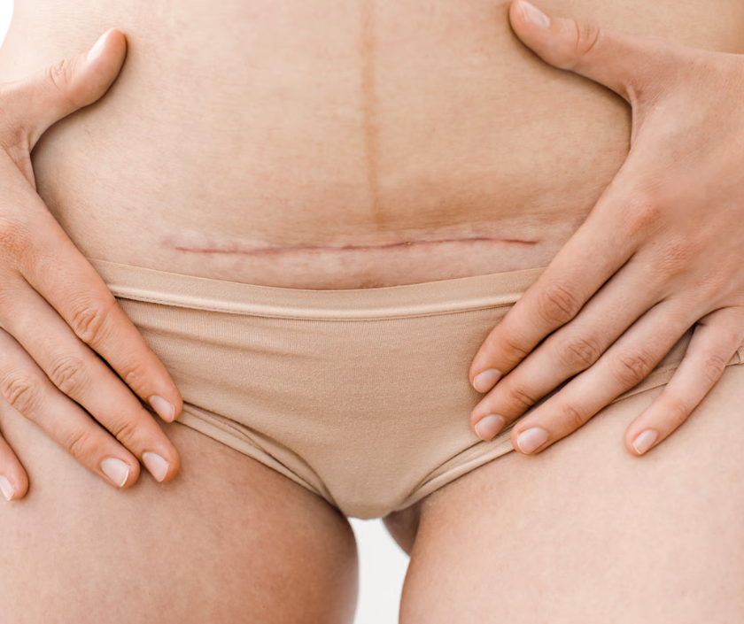 Genital Scar Revision in India by Dr. Ashutosh Shah, Elegance Clinic