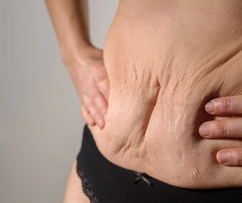 Labia Majora Reduction in India by Dr. Ashutosh Shah, Elegance Clinic