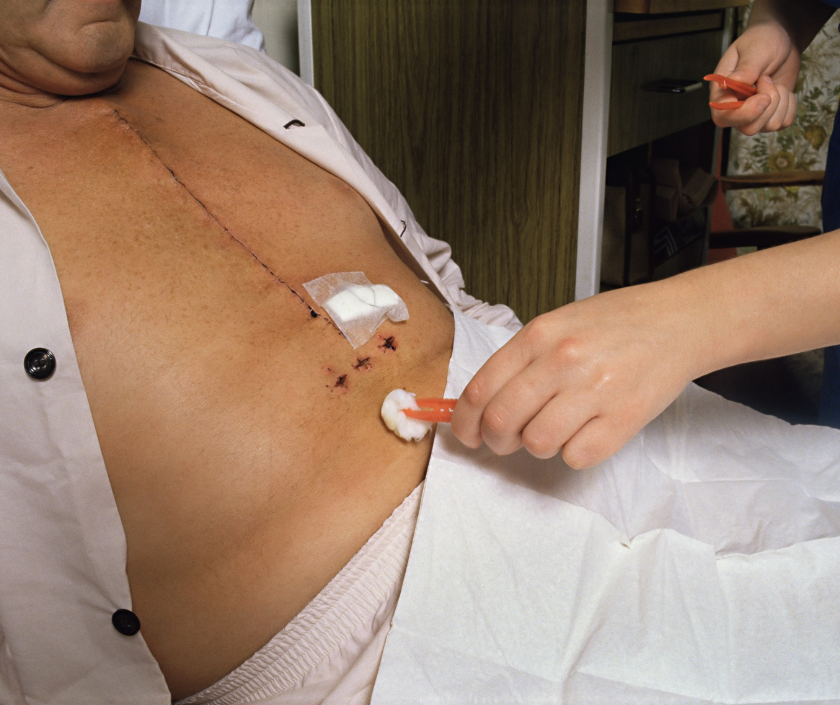 Scar Management After Chest Surgery, Elegance Clinic, Surat Scar Management After Chest Surgery, Trans Wellness Care in India at Elegance Clinic, Surat