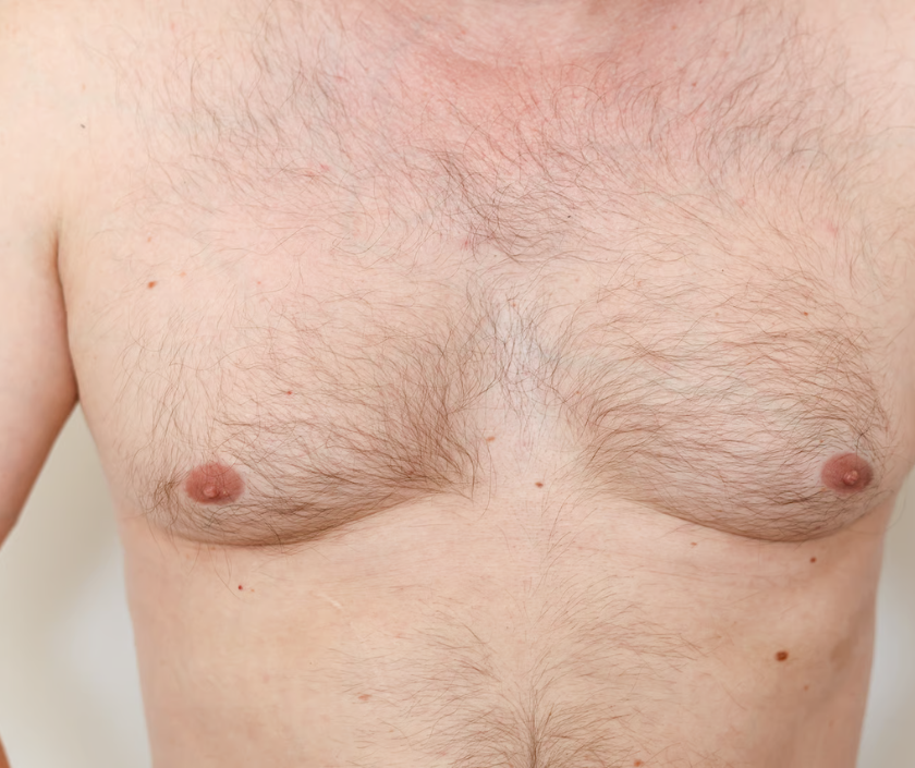 Dog Ear Correction, FTM Top Surgery in India at Elegance Clinic, Surat