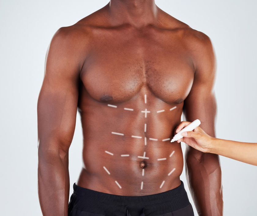 Feminization and Masculinization Liposculpture, Elegance Clinic, Surat Feminization and Masculinization Liposculpture, Chest Contouring in India at Elegance Clinic, Surat