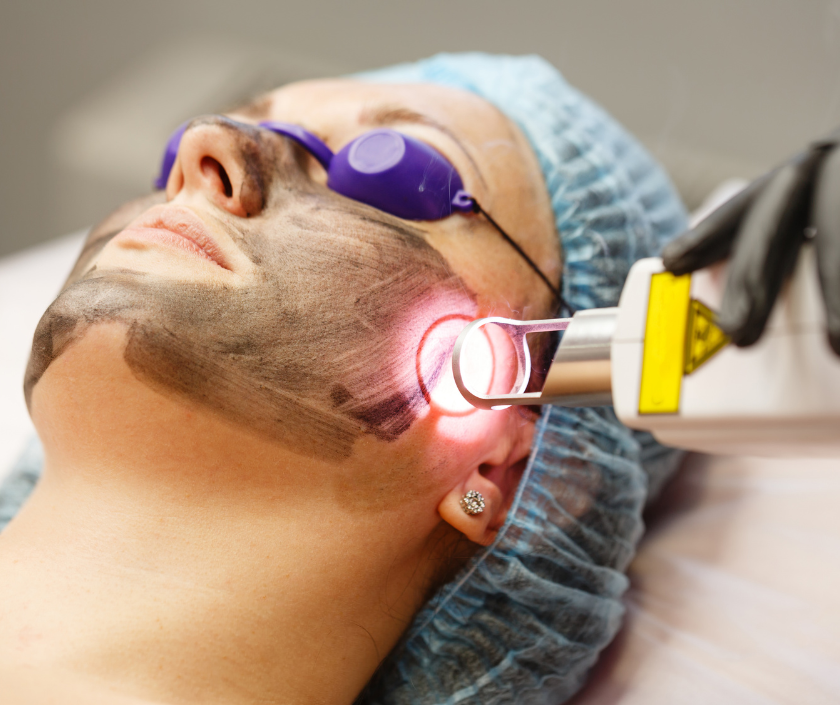 Carbon Laser Treatment, Elegance Clinic, Surat Carbon Laser Treatment, Laser Intimate Whitening in India at Elegance Clinic, Surat