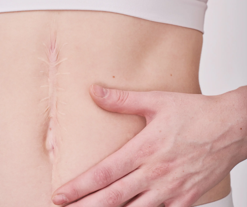 Episiotomy Scar Treatment, Non Surgical, Scar Improvement in India at Elegance Clinic, Surat