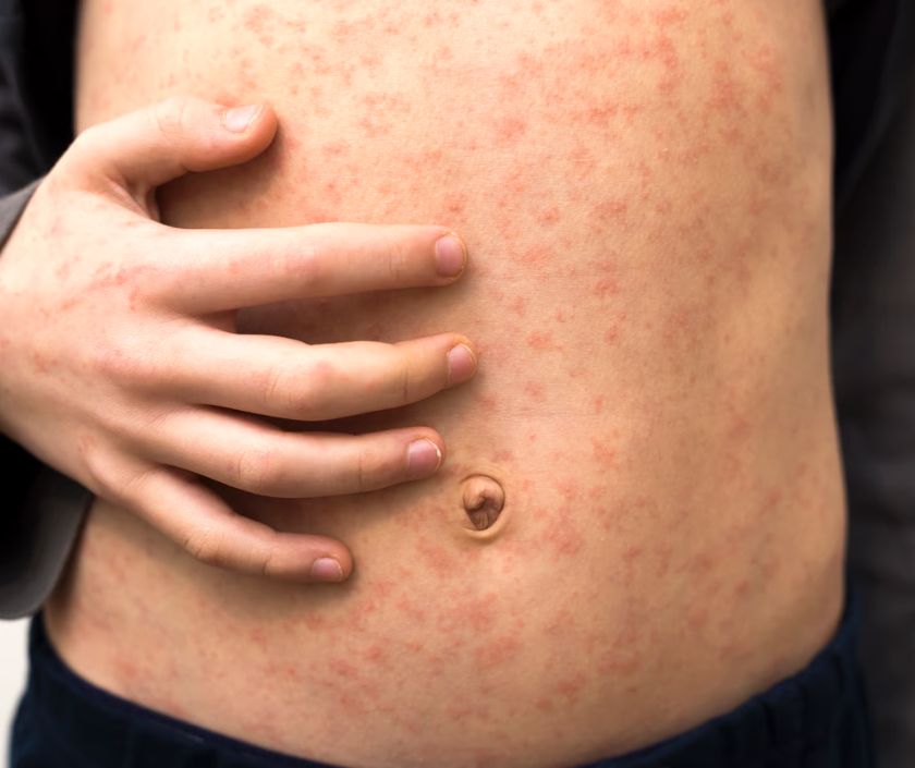 Folliculitis Treatment, Elegance Clinic, Surat Folliculitis Treatment, Ingrown Hair & Folliculitis in India at Elegance Clinic, Surat