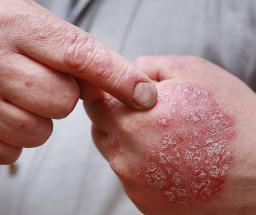Fungal Infection in India by Dr. Ashutosh Shah, Elegance Clinic