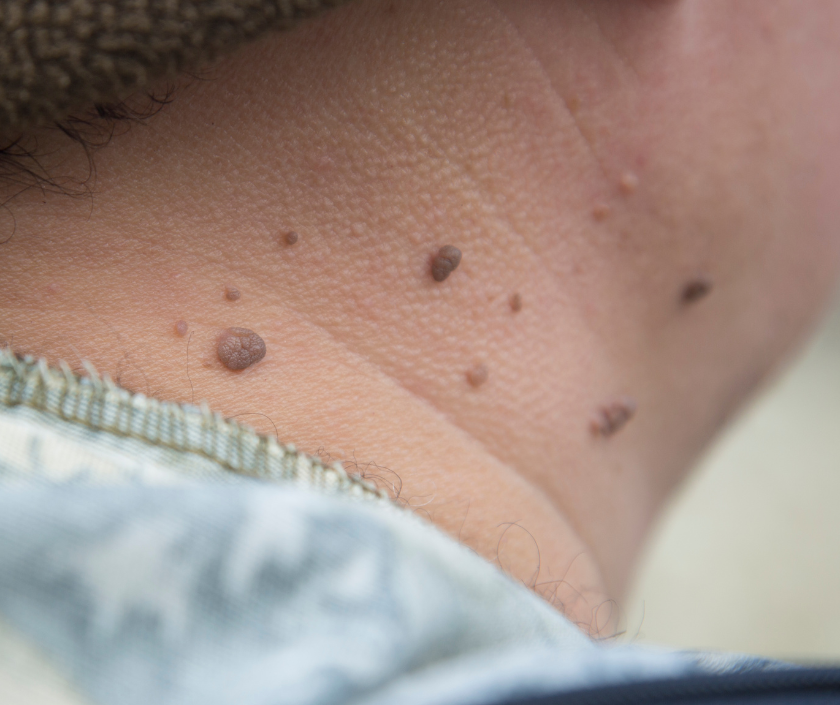 Genital Wart Removal in India by Dr. Ashutosh Shah, Elegance Clinic