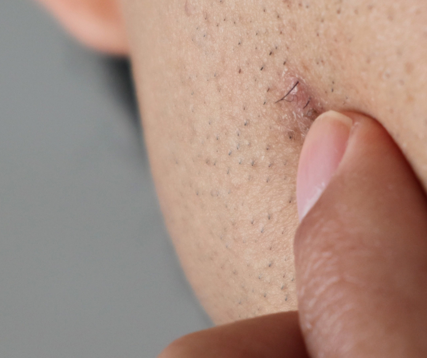 Ingrown Hair & Folliculitis in India by Dr. Ashutosh Shah, Elegance Clinic