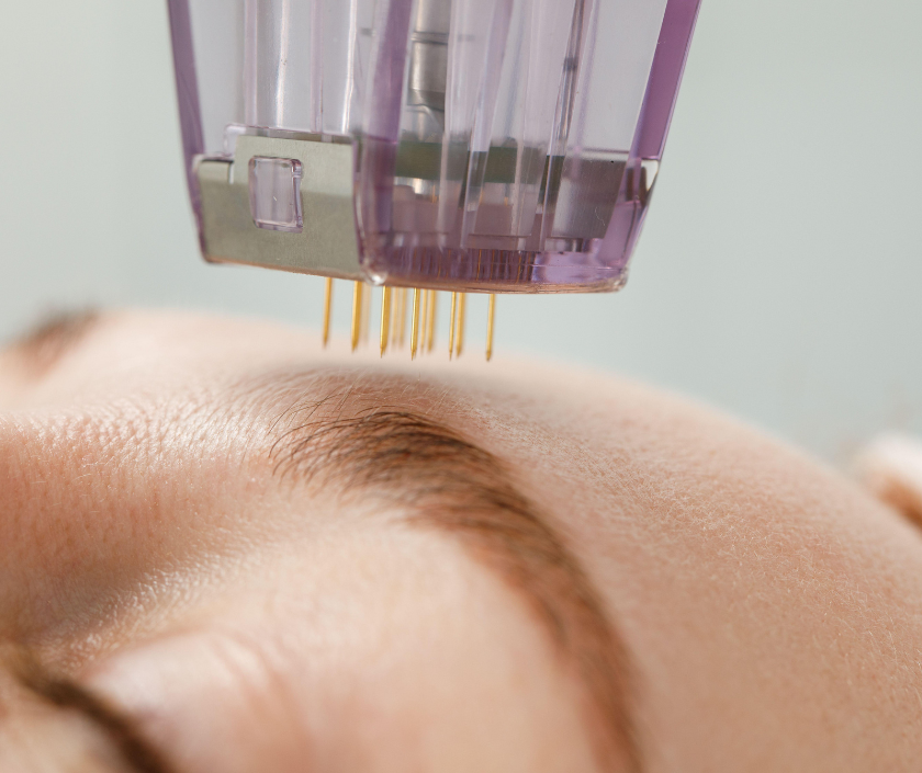 Combination RF and Microneedling, Elegance Clinic, Surat Combination RF and Microneedling, RF Vaginal Tightening in India at Elegance Clinic, Surat