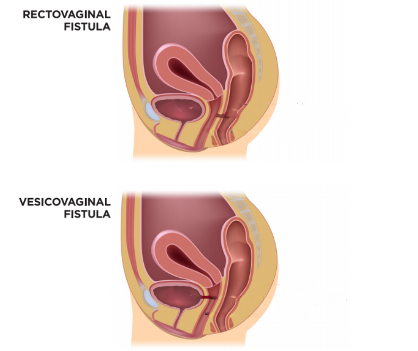 Rectovaginal and Vesicovaginal Fistula Repair in India by Dr. Ashutosh Shah, Elegance Clinic